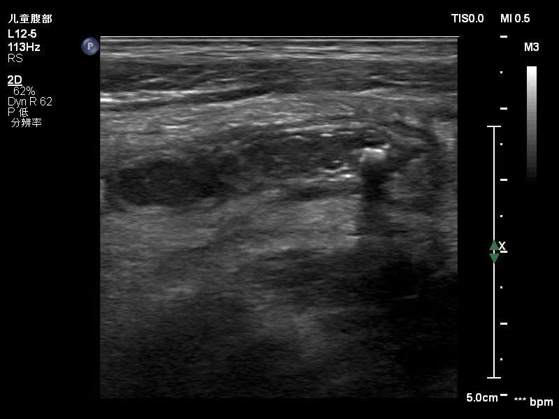 徐州市儿童医院科普：小儿腹痛之“阑尾炎”