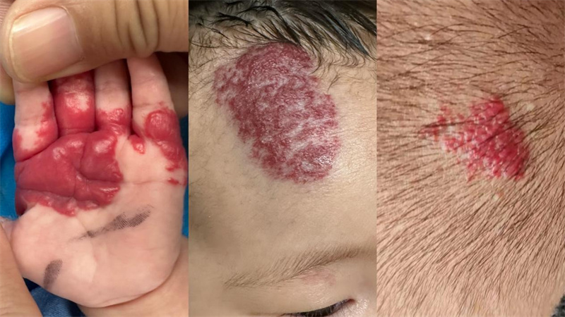 婴幼儿血管瘤病因发病时间症状以及治疗方案