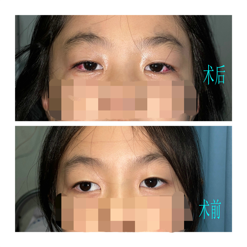 徐州市儿童医院专家：治疗方法得当 “目不斜视”不再是梦想