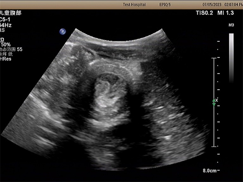 徐州市儿童医院科普：小儿腹痛之“肠套叠” 留心症状与家长须知