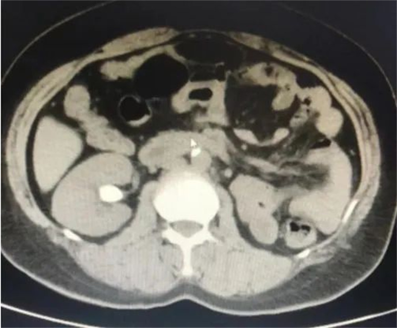泌尿外科新技术治疗上尿路结石，安全高效碎石清石