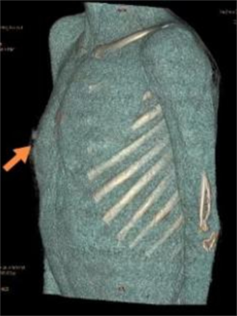 徐州市儿童医院科普：关注儿童及青少年胸壁隆起 叉状肋