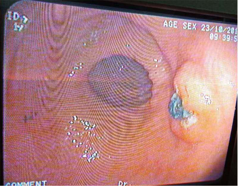 徐州市儿童医院科普：祸从口入 浅谈儿童消化道异物